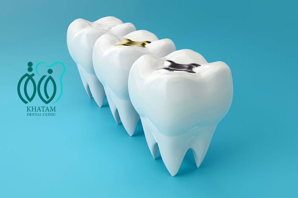 جنس مواد پرکننده دندان چیست ؟ جنس مواد پرکننده دندان چیست ؟