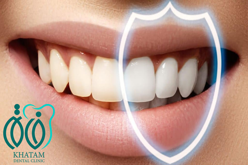 طول عمر کامپوزیت دندان چقدر است ؟ طول عمر کامپوزیت دندان چقدر است ؟