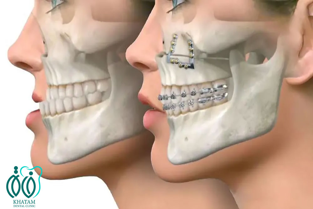 انواع جراحی فک بالا و پایین انواع جراحی فک بالا و پایین