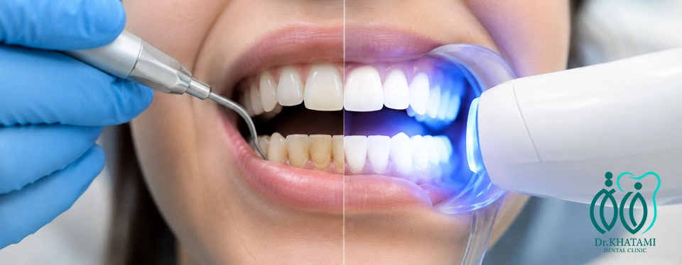 تفاوت جرمگیری و بلیچینگ برای اصلاح طرح لبخند تفاوت جرمگیری و بلیچینگ برای اصلاح طرح لبخند