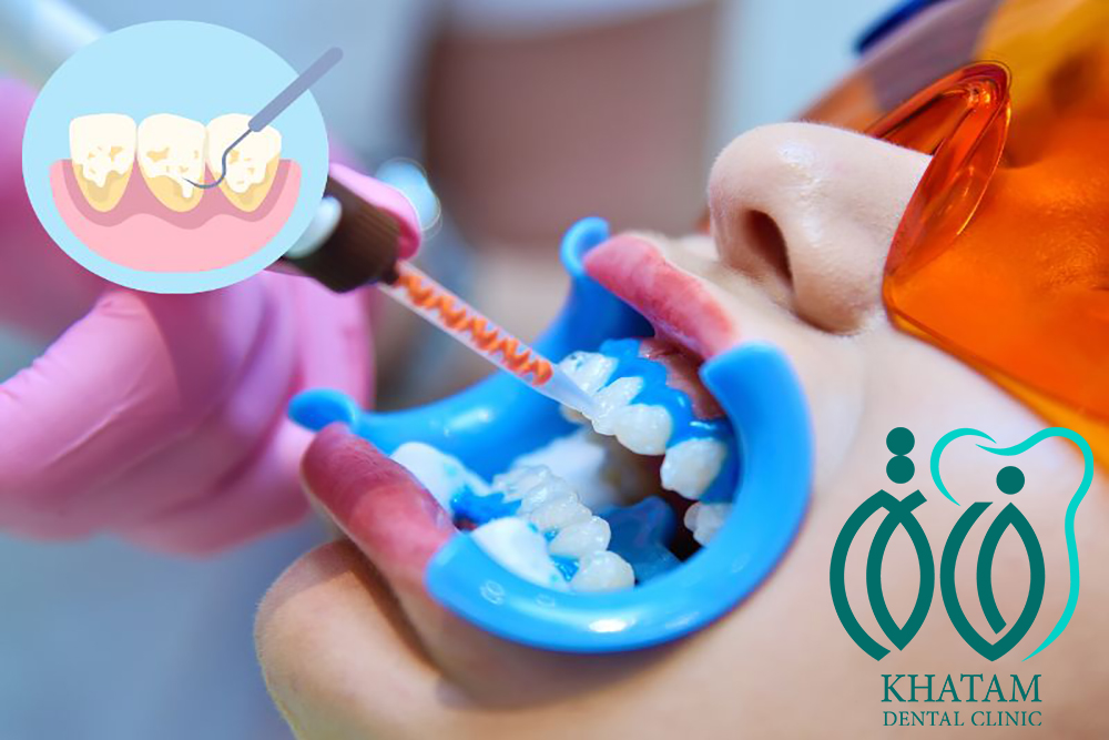 تفاوت جرم گیری و بلیچینگ دندان ( جرم گیری یا بلیچینگ کدام بهتر است ؟ ) تفاوت جرم گیری و بلیچینگ دندان ( جرم گیری یا بلیچینگ کدام بهتر است ؟ )