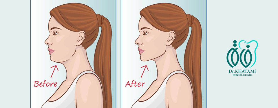 جراحی زیبایی فک چیست و برای چه کسانی مناسب است؟ جراحی زیبایی فک چیست و برای چه کسانی مناسب است؟