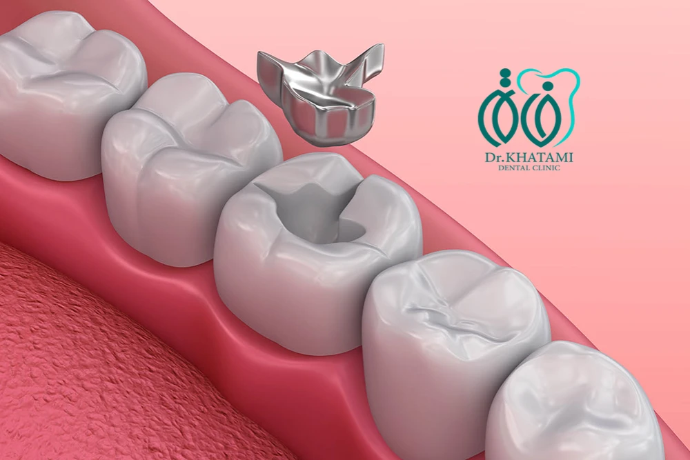 آلیاژ آمالگام چیست؟ + انواع، قیمت، مزایا و معایب + تفاوتها آلیاژ آمالگام چیست؟ + انواع، قیمت، مزایا و معایب + تفاوتها