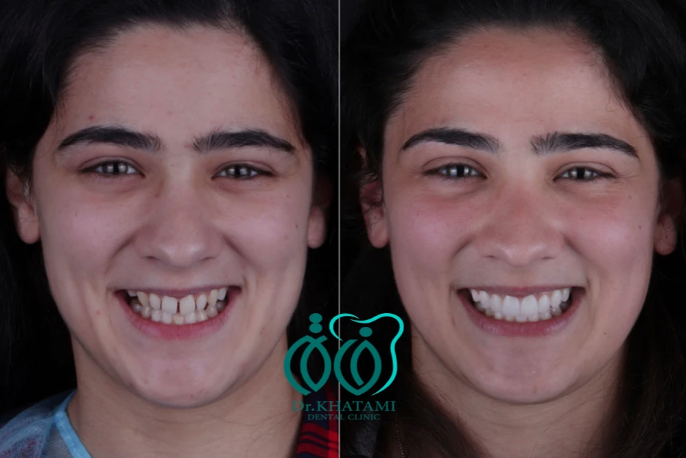لمینت دندان لبه شیشه ای + قیمت، مزایا و معایب، ماندگاری لمینت دندان لبه شیشه ای + قیمت، مزایا و معایب، ماندگاری