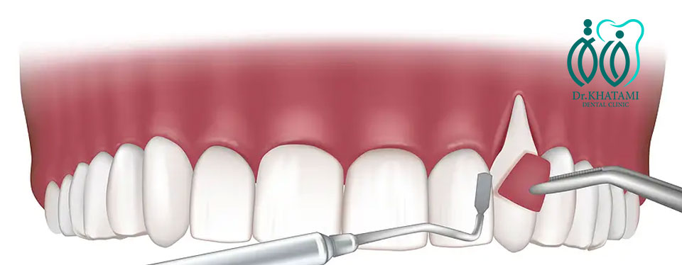 پیوند لثه چیست و چگونه انجام میشود؟ پیوند لثه چیست و چگونه انجام میشود؟