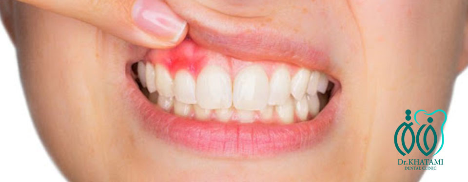 چگونه علائم آبسه دندان را تشخیص دهیم؟ چگونه علائم آبسه دندان را تشخیص دهیم؟