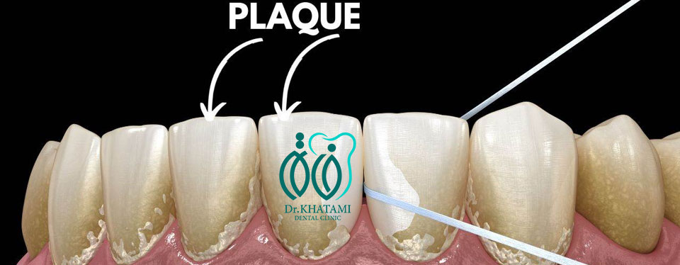 پلاک دندانی چیست؟ پلاک دندانی چیست؟