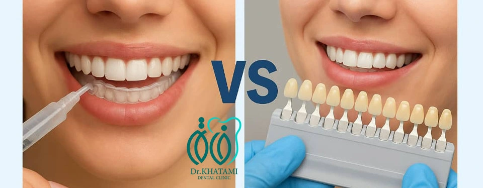 مقایسه بلیچینگ خانگی و مطب (Home vs Office) مقایسه بلیچینگ خانگی و مطب (Home vs Office)