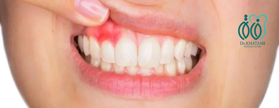 نحوه تخلیه آبسه دندان چگونه است؟ نحوه تخلیه آبسه دندان چگونه است؟