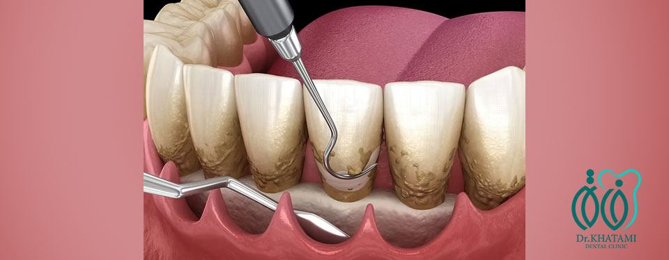 جراحی فلپ لثه چیست و چه زمانی انجام میشود؟ جراحی فلپ لثه چیست و چه زمانی انجام میشود؟