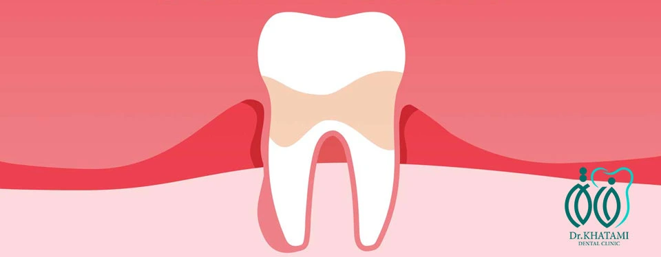 التهاب لثه چیست و چگونه درمان میشود؟ التهاب لثه چیست و چگونه درمان میشود؟
