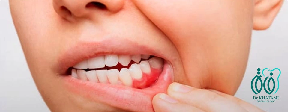 چرا دندان عصب کشی شده دچار عفونت میشود؟ چرا دندان عصب کشی شده دچار عفونت میشود؟