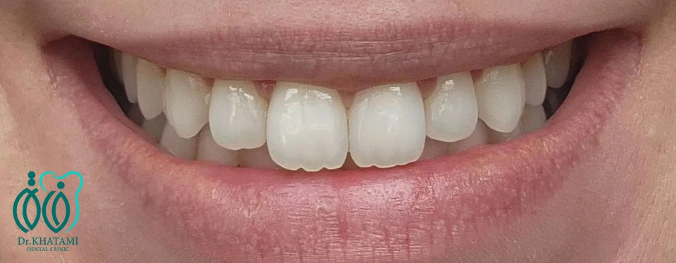 لمینت دندان خرگوشی چیست؟ لمینت دندان خرگوشی چیست؟