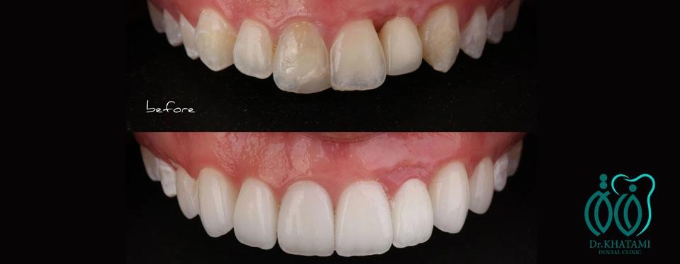 لمینت بدون تراش دندان (No‑Prep Veneers) چیست و چه افرادی میتوانند انجام دهند؟ لمینت بدون تراش دندان (No‑Prep Veneers) چیست و چه افرادی میتوانند انجام دهند؟