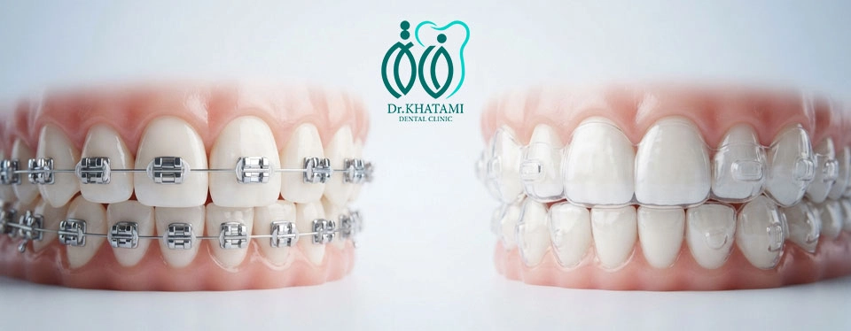ارتودنسی نامرئی را انتخاب کنیم یا ارتودنسی ثابت؟ ارتودنسی نامرئی را انتخاب کنیم یا ارتودنسی ثابت؟