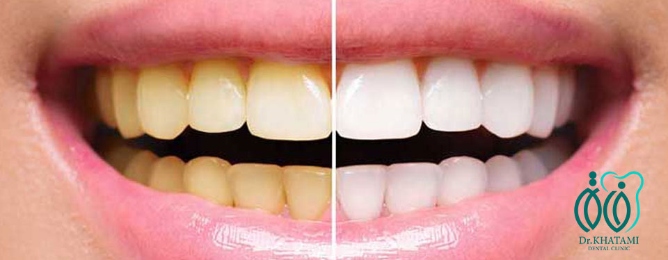 علت زرد شدن دندان چیست؟ علت زرد شدن دندان چیست؟