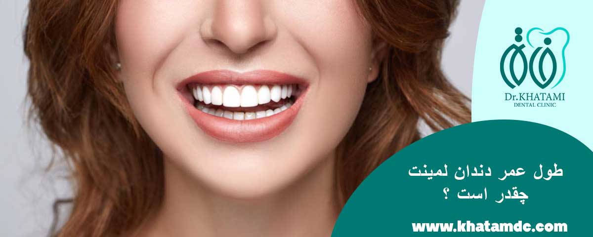 طول عمر لمینت دندان