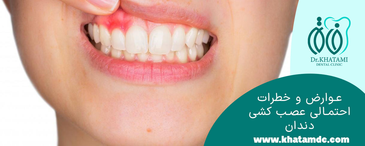 عوارض و خطرات احتمالی عصب کشی دندان