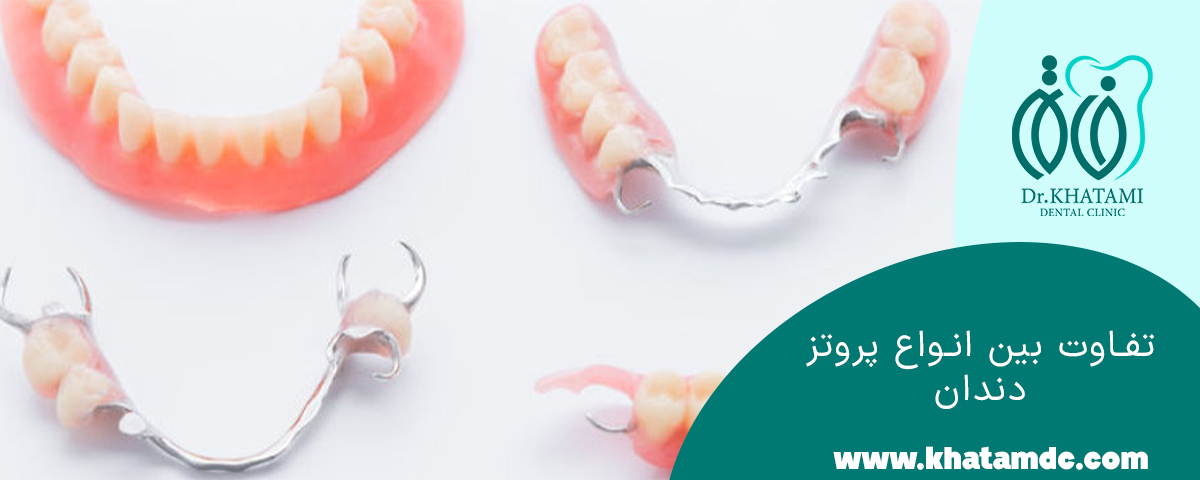 تفاوت بین انواع پروتز دندان