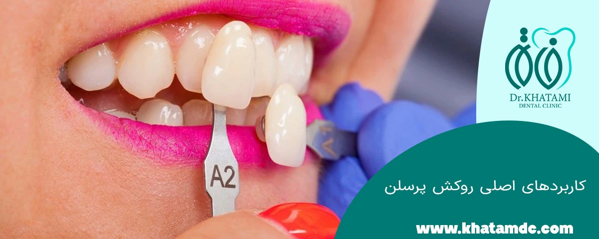 کاربرد روکش پرسلن