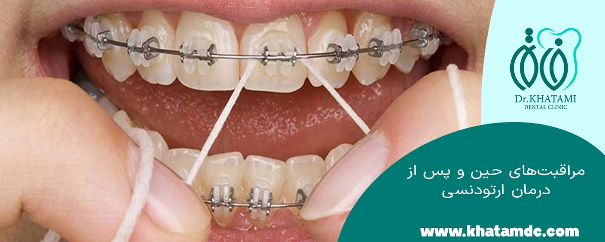 مراقبت از ارتودنسی