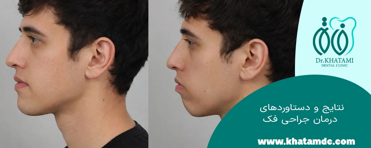 نتیج و دستاورد جراحی فک